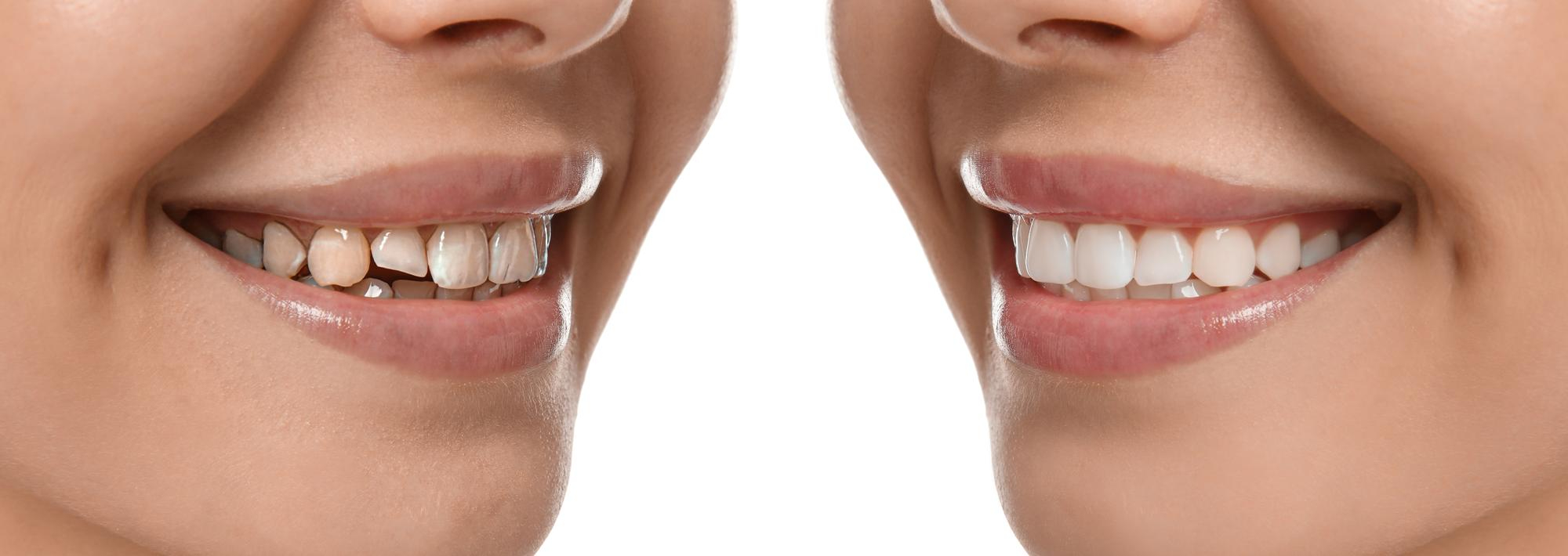 smile design transformation