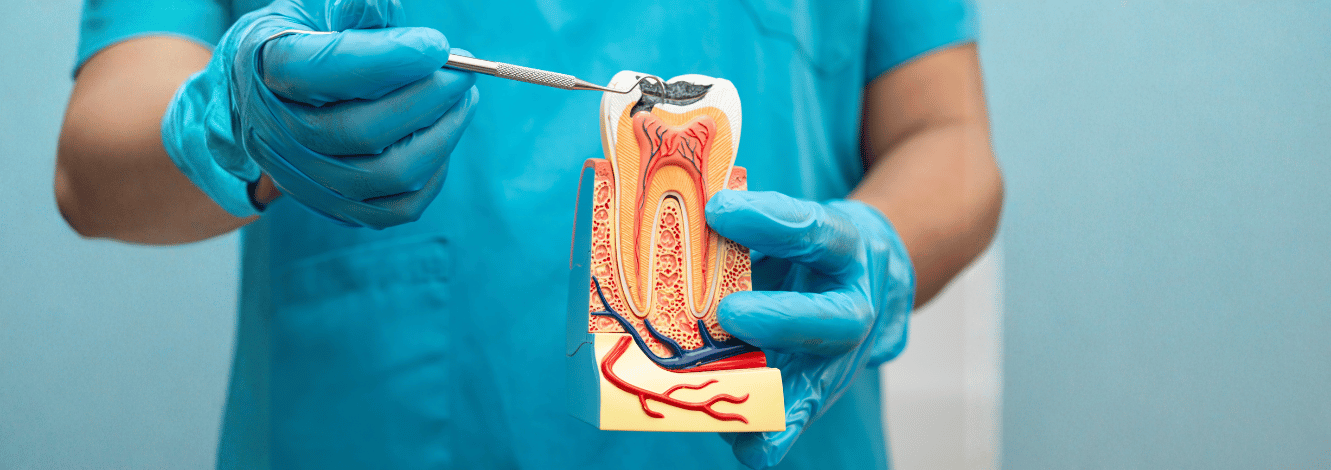root canal