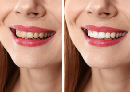 Smile Makeover