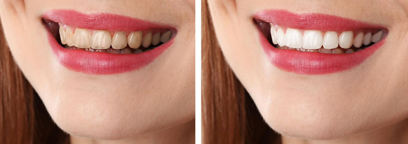 Smile Makeover
