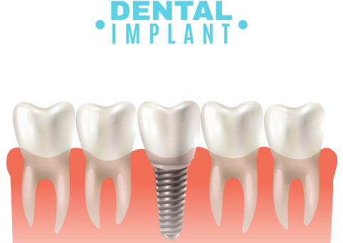 Dental Implants at Bandra