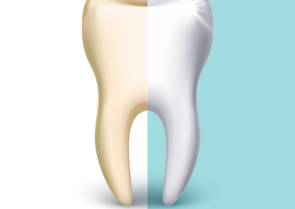 Professional Teeth Whitening