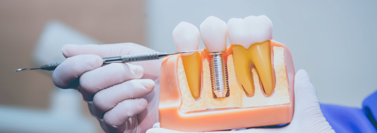 Dental Implant