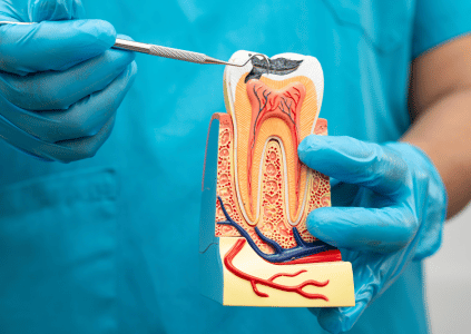 root canal