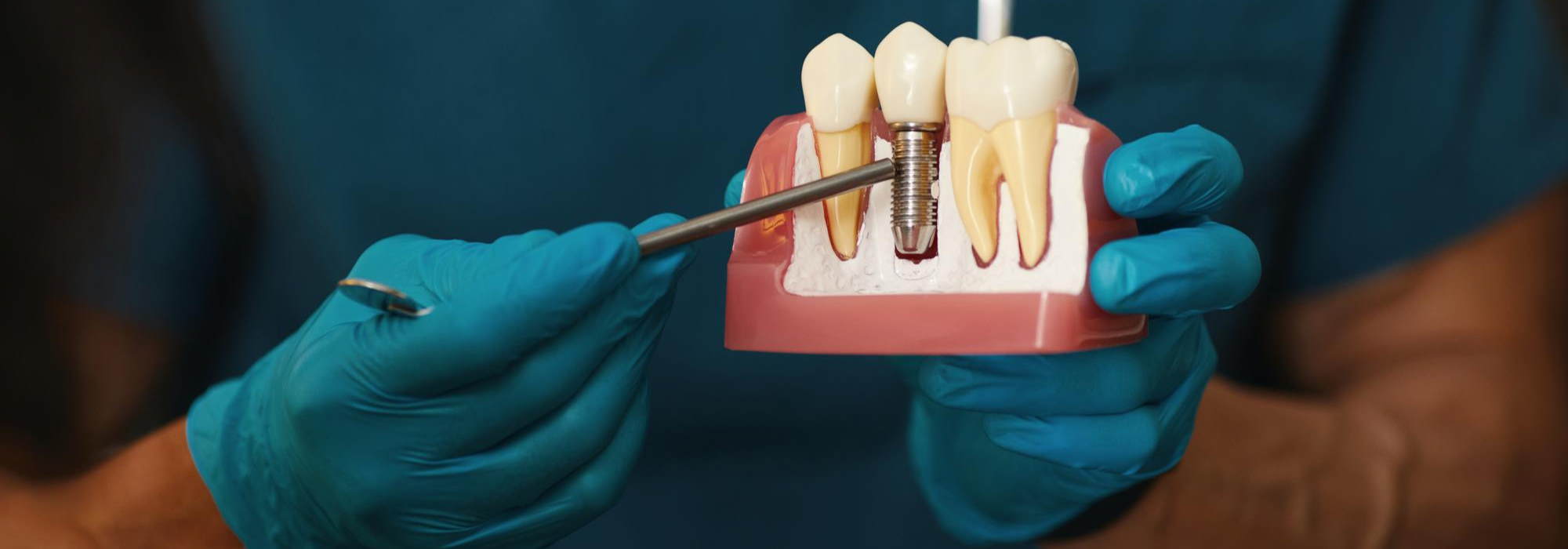root canal