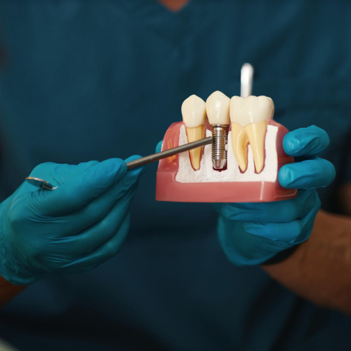 root canal